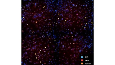 Ex-vivo high-throughput drug screening in bladder cancers