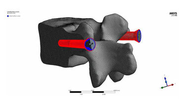 Example of RBF Morph design technology in a study of surgical screws in a vertebra, by Marco Sensale