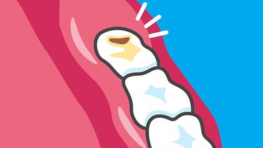 Graphic of three teeth in a person's mouth, one of which has a cavity.