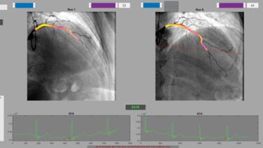 Angiogram showing the segmentation process to create a 3D model of an artery.