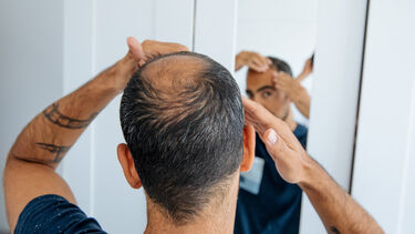 Balding man