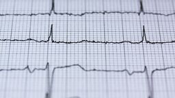 A photograph of an electrocardiogram showing a normal heart rate.